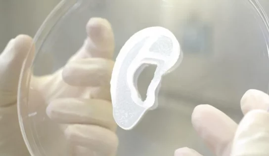 La primera oreja impresa en 3D que se ha transplantado a un paciente
