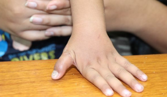Especialistas reimplantan dedo pulgar a niño de 1 año en Nuevo León